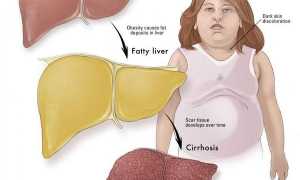 Как лечить жировой гепатоз печени медикаментами?
