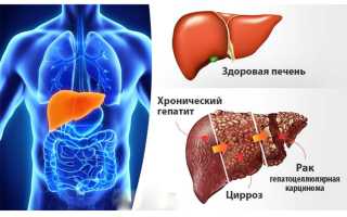 Классификация и патогенез хронического гепатита