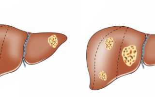Метастазы рака в печень