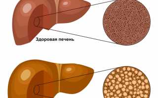 Что такое диффузные изменения печени по типу жирового гепатоза?