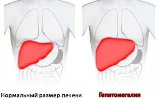 Что делать, если увеличена печень?