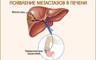 Метастазы в печени: симптомы, стадии и методы лечения