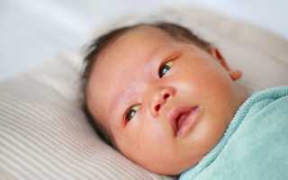 Желтуха новорожденных: код по мкб 10 у детей
